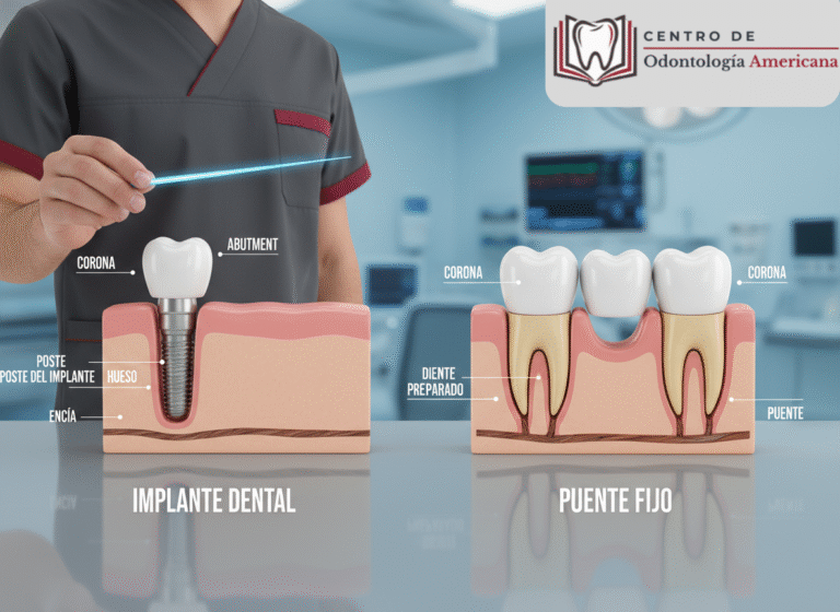 Diagrama comparativo de Implante Dentales y Puente Fijo.